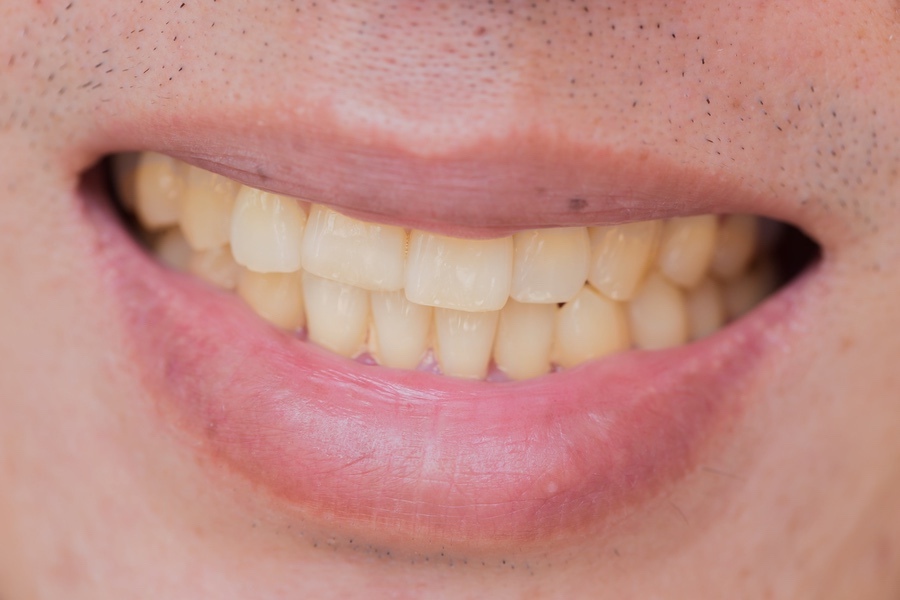 yellow teeth in male from smoke and coffee